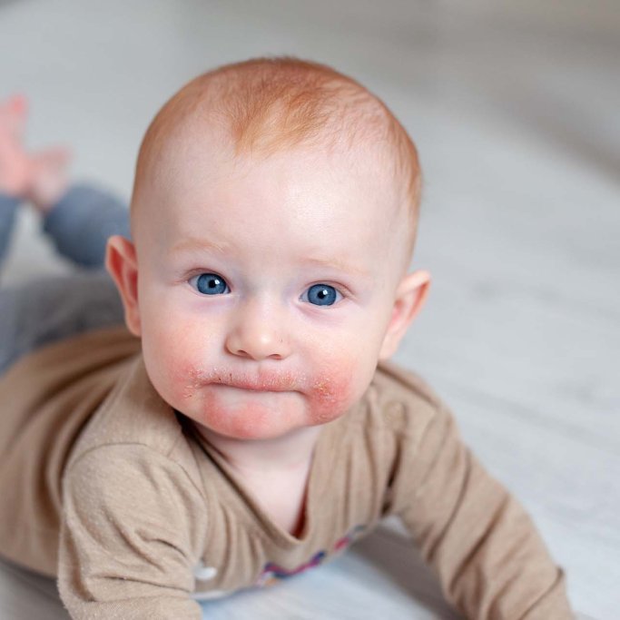 Bébé avec des plaques d'eczéma autour de la bouche