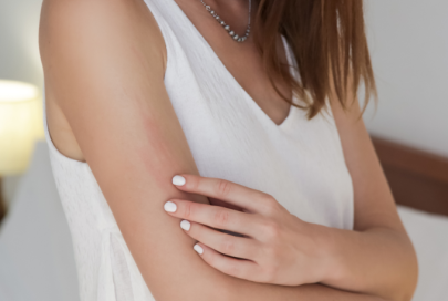 Plaques d’eczéma : symptômes, causes et traitement