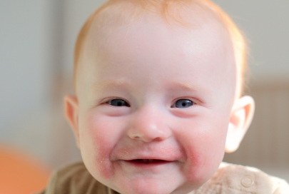 L’eczéma du visage