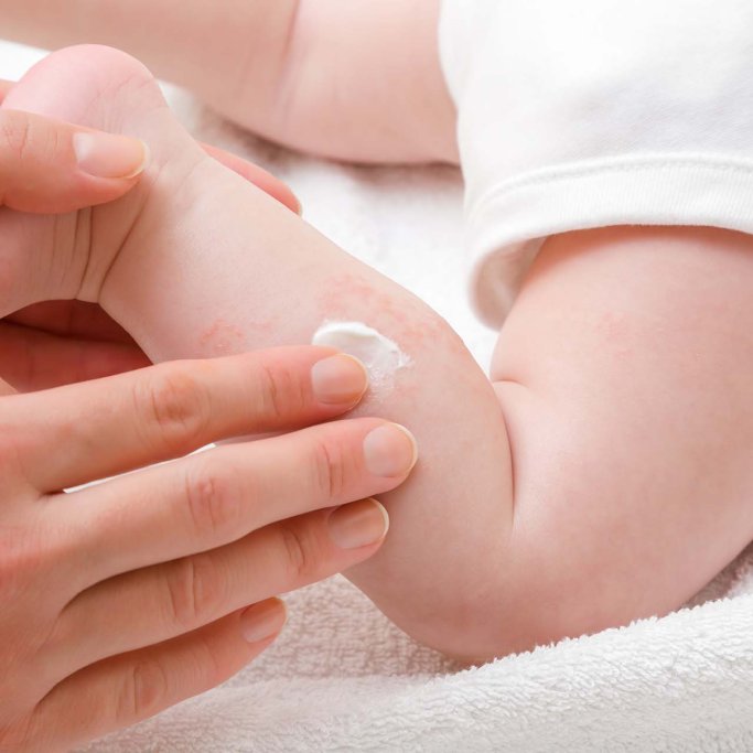 Eczéma atopique : le reconnaître et le soulager