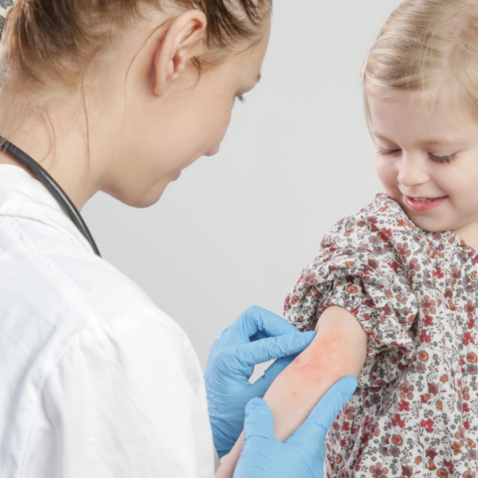 Eczéma traitement : comment traiter et soulager l’eczéma