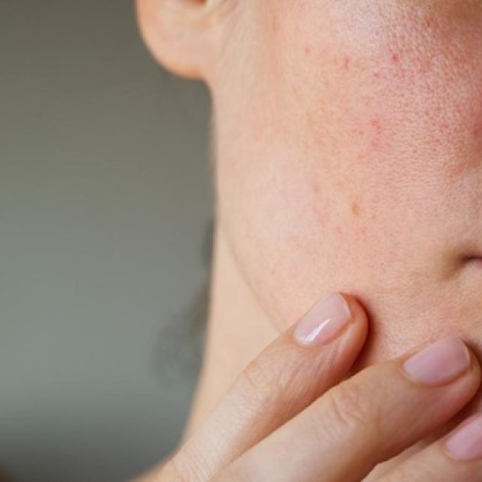 Une peau sèche et très sèche est par nature fragile, facilement irritable