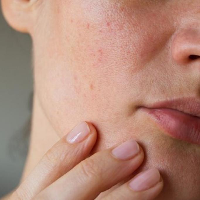 Une peau sèche et très sèche est par nature fragile, facilement irritable