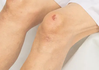 Xérose  personne âgée