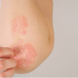 Psoriasis
