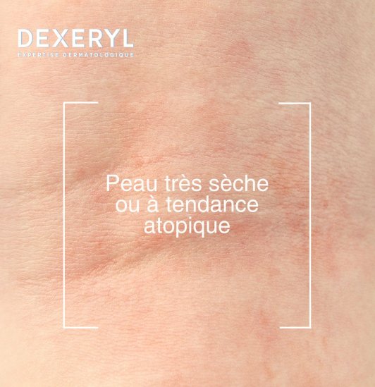 Peau très sèche ou à tendance atopique